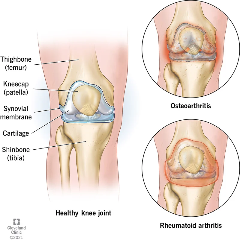 Arthritis illustration